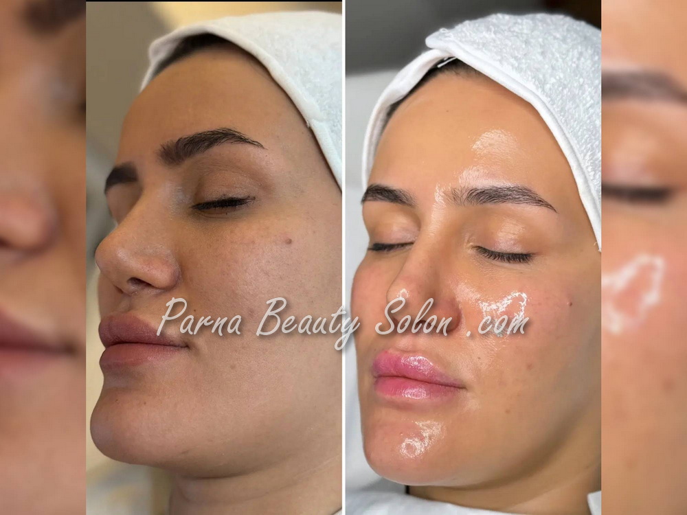 پاکسازی پوست با دستگاه فیشیال 1