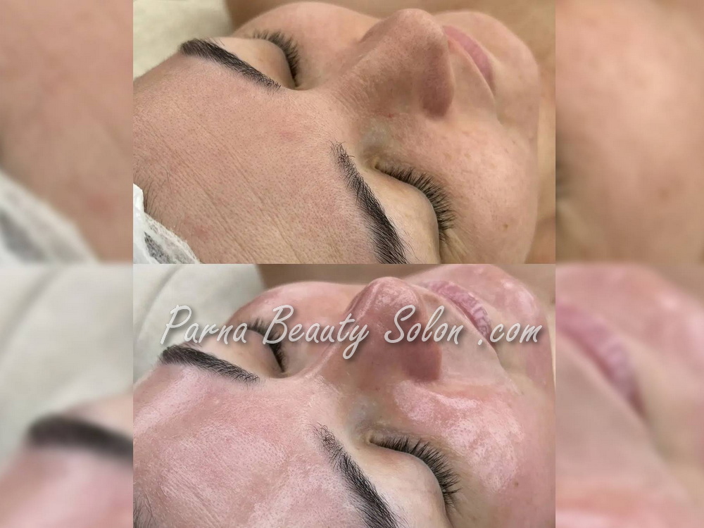 پاکسازی پوست با دستگاه فیشیال 5